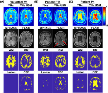 Zum Artikel "New paper: Quantitative 7T sodium magnetic resonance imaging of the human brain using a 32-channel phased-array head coil: Application to patients with secondary progressive multiple sclerosis"