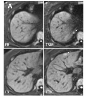 Zum Artikel "Neues Paper: Relevance of lesion size in navigator-triggered and free-breathing diffusion-weighted liver MRI"