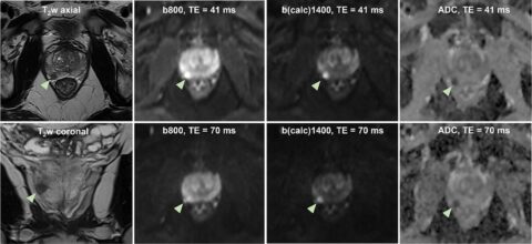 Zum Artikel "New paper: Pros and Cons of High-Performance Gradient Enabled Short-TE Prostate DWI: A Prospective Study"