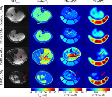 Zum Artikel "Neues Paper: Determination of Tissue Potassium and Sodium Concentrations in Dystrophic Skeletal Muscle Tissue Using Combined Potassium (39K) and Sodium (23Na) MRI at 7T"