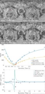 Zum Artikel "New paper: Relevance of Prostatic Fluid on the Apparent Diffusion Coefficient: An Inversion Recovery Diffusion-Weighted Imaging Investigation"