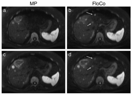 Zum Artikel "Neues Paper: Flow-Compensated vs. Monopolar Diffusion Encodings: Differences in Lesion Detectability Regarding Size and Position in Liver Diffusion-Weighted MRI"