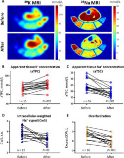 Zum Artikel "Neues Paper: 7-T Potassium (39K) MRI to Assess Muscle K+ Depletion in Primary Aldosteronism"