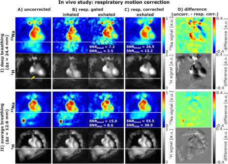 Zum Artikel "Neues Paper: Improved Myocardial Sodium Quantification at 7 T Using Interleaved 23Na/1H pTx MRI With Motion and Anatomy-Based B1 Correction"